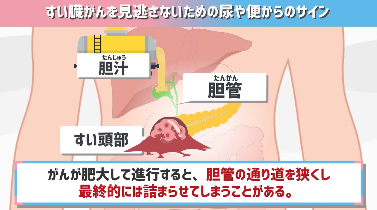 膵臓がん症状セルフチェック｜背中の痛みや黄疸は見逃せない危険信号