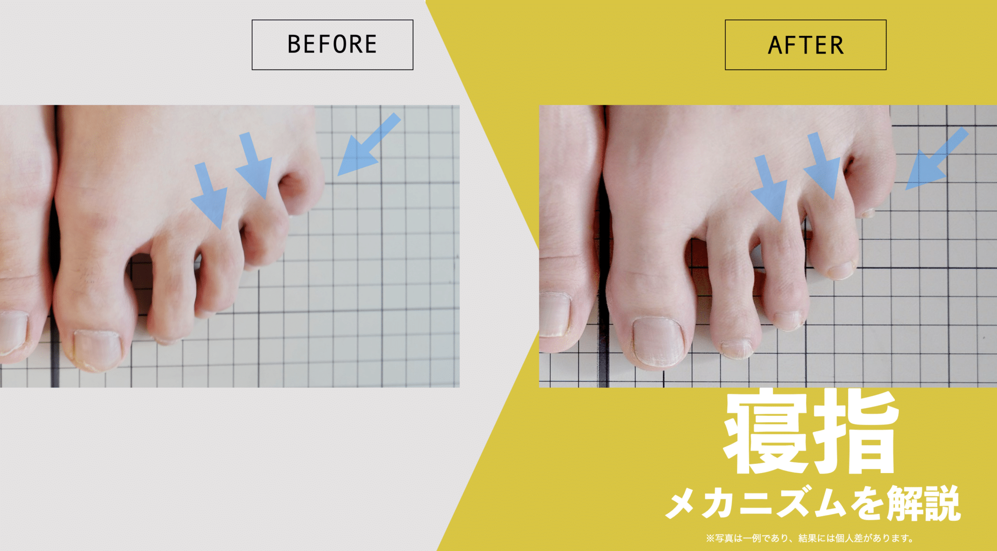 足の小指が横を向く寝指の原因とは？爪の潰れと正しい治し方を徹底解説