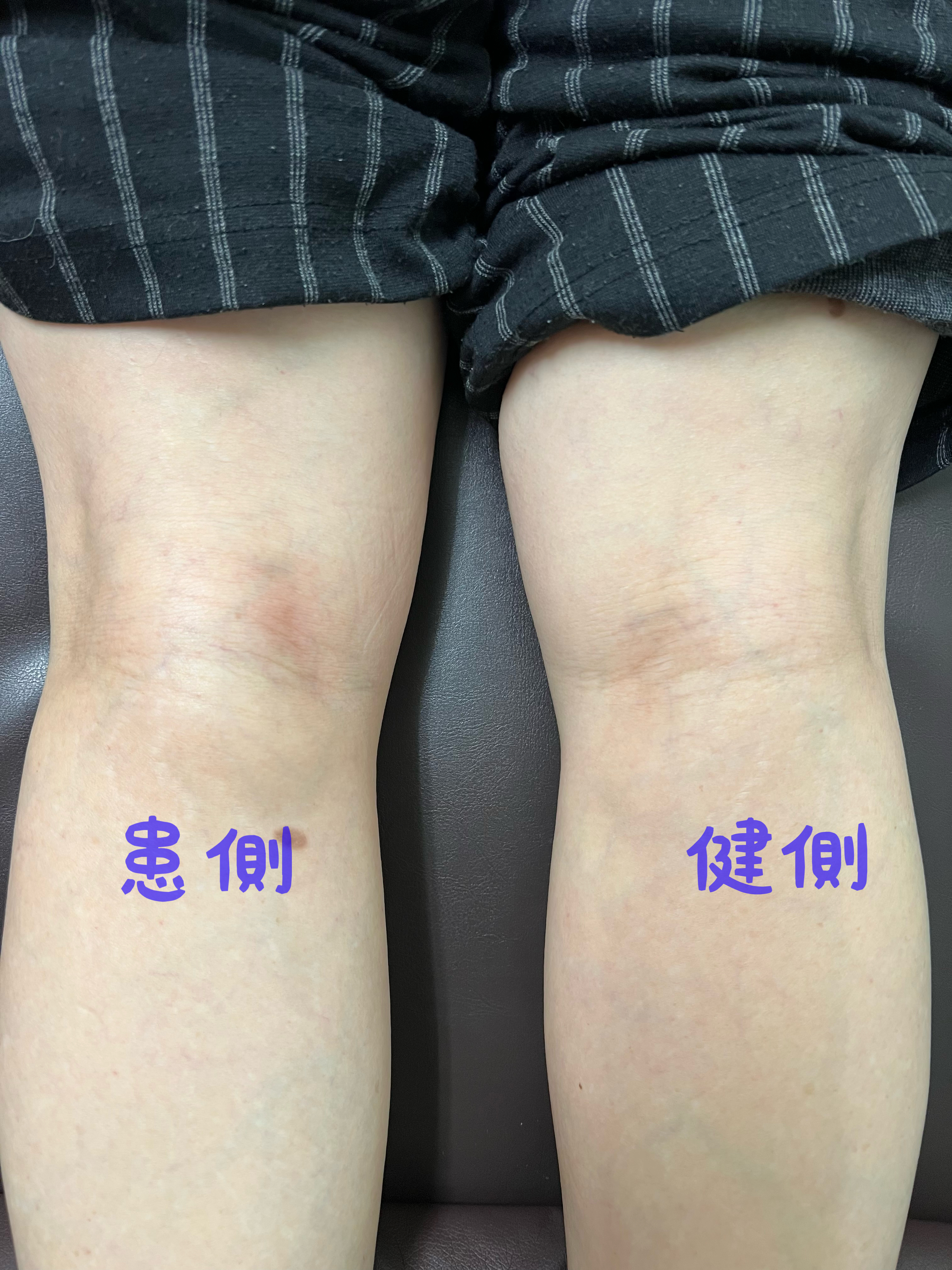 膝裏のぽっこりした膨らみは病気？痛くないしこりの正体と治し方