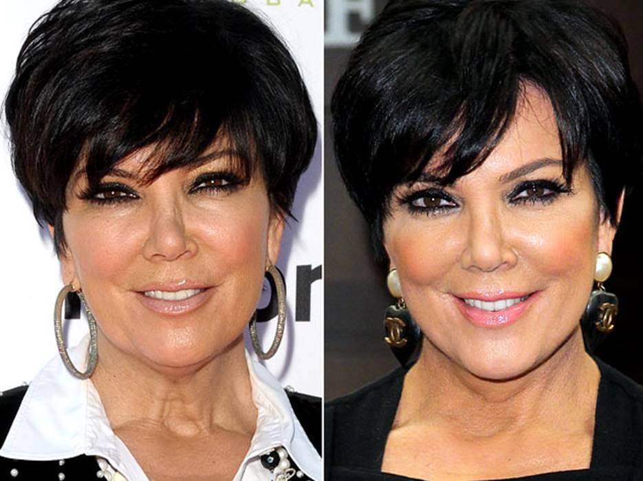 Kris Jenner Before and After Face Lift
