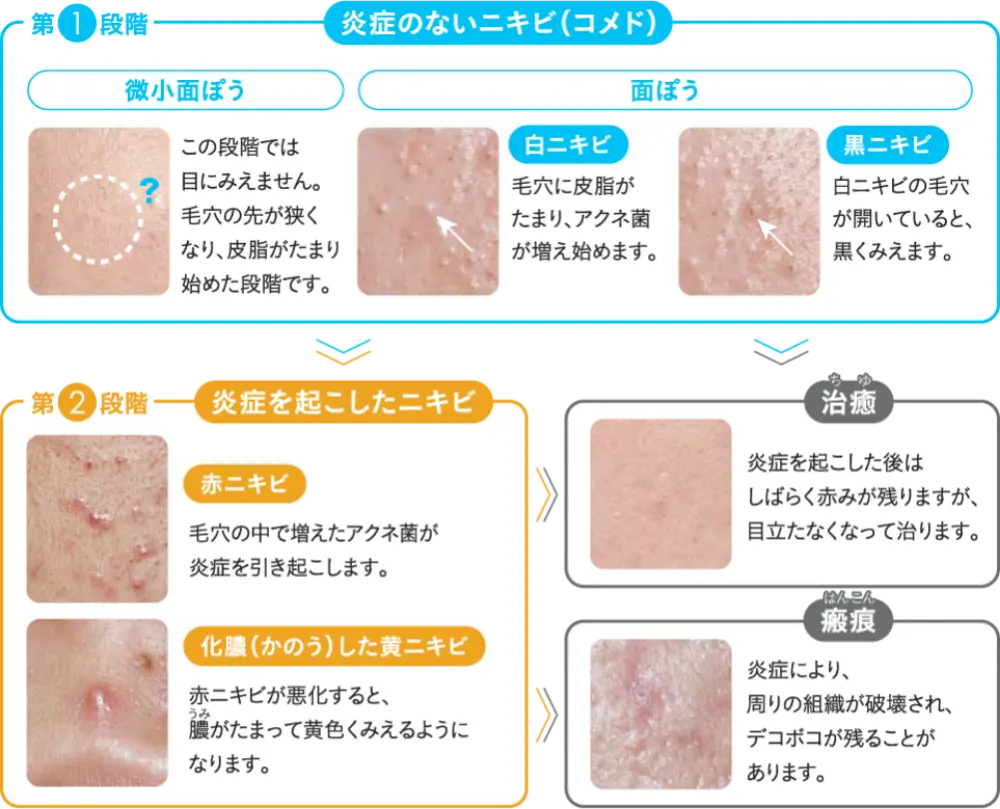 なぜ治らない？吹き出物の正体と粉瘤・皮膚炎の決定的見分け方
