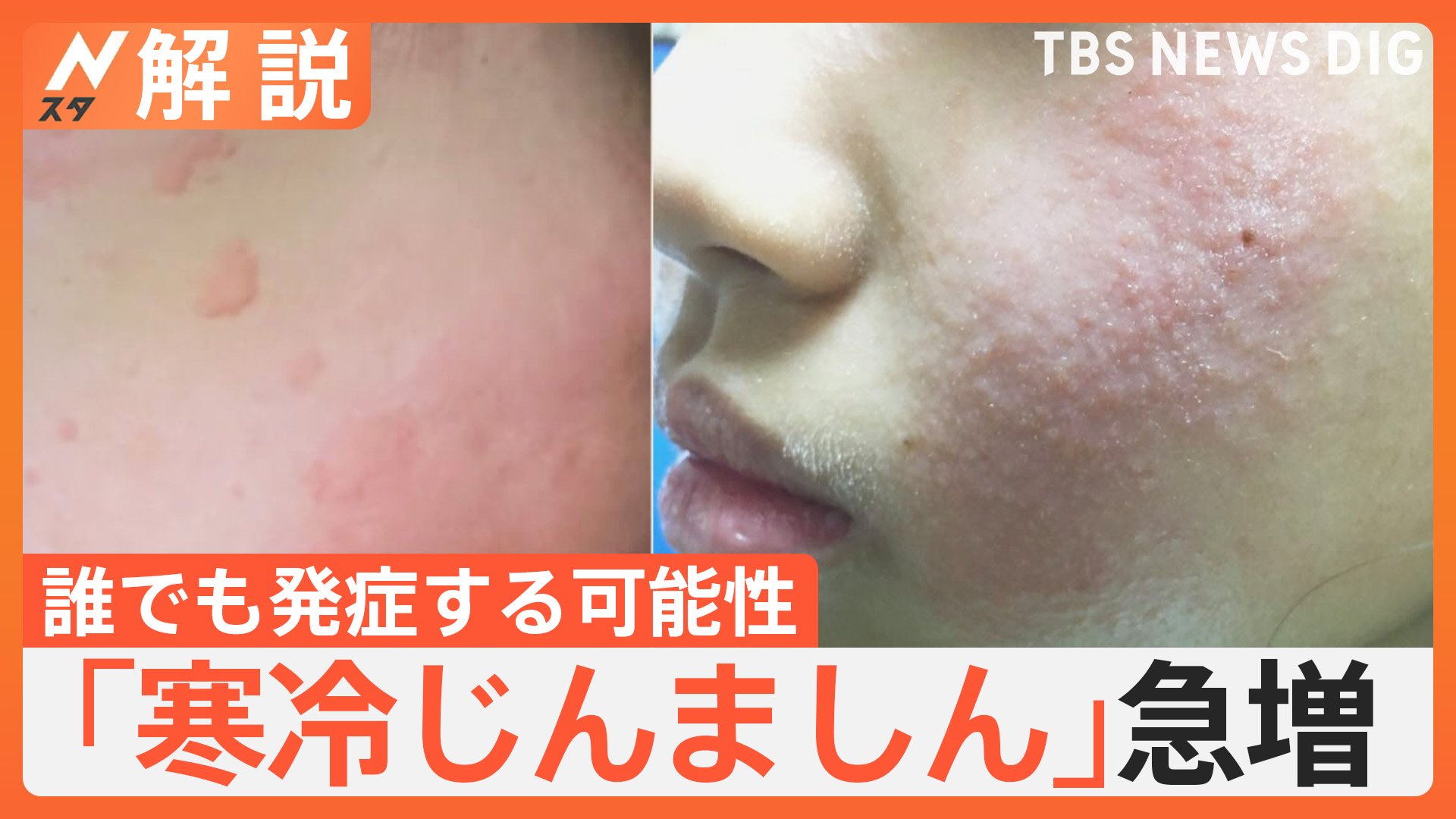 寒冷蕁麻疹の原因と治し方｜急なかゆみと腫れの危険度を徹底検証
