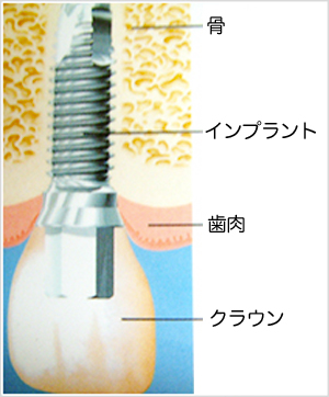 【動画まとめ】 吉田正尚 歯 インプラント 徹底解説＆真相まとめ #671