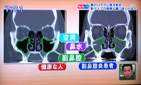 【話題】 好 酸 球 性 副 鼻腔 炎 芸能人 最新出演情報まとめ #992