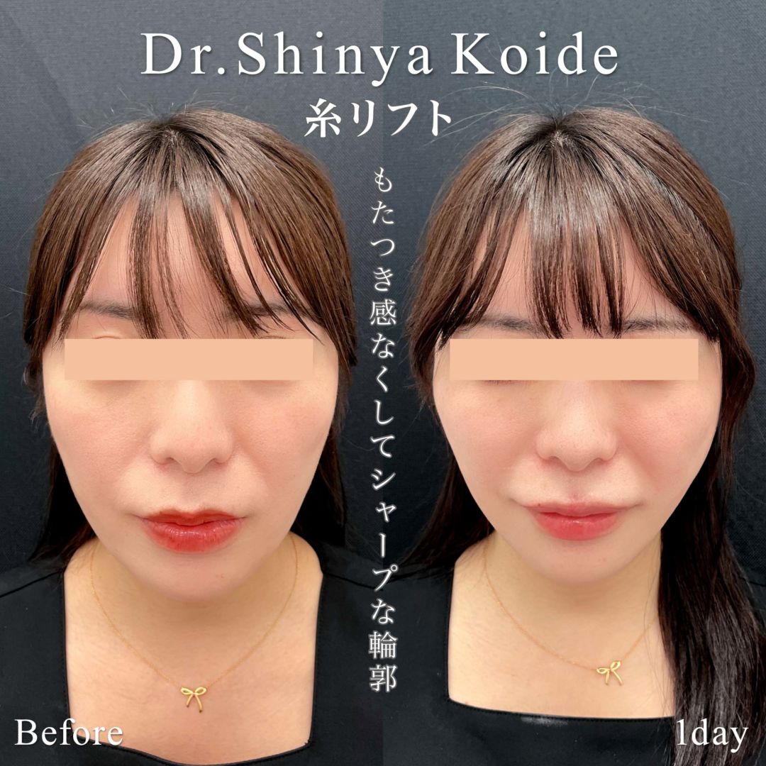 糸リフト後のひきつれと凹みは治る？原因と修正タイミングを解説