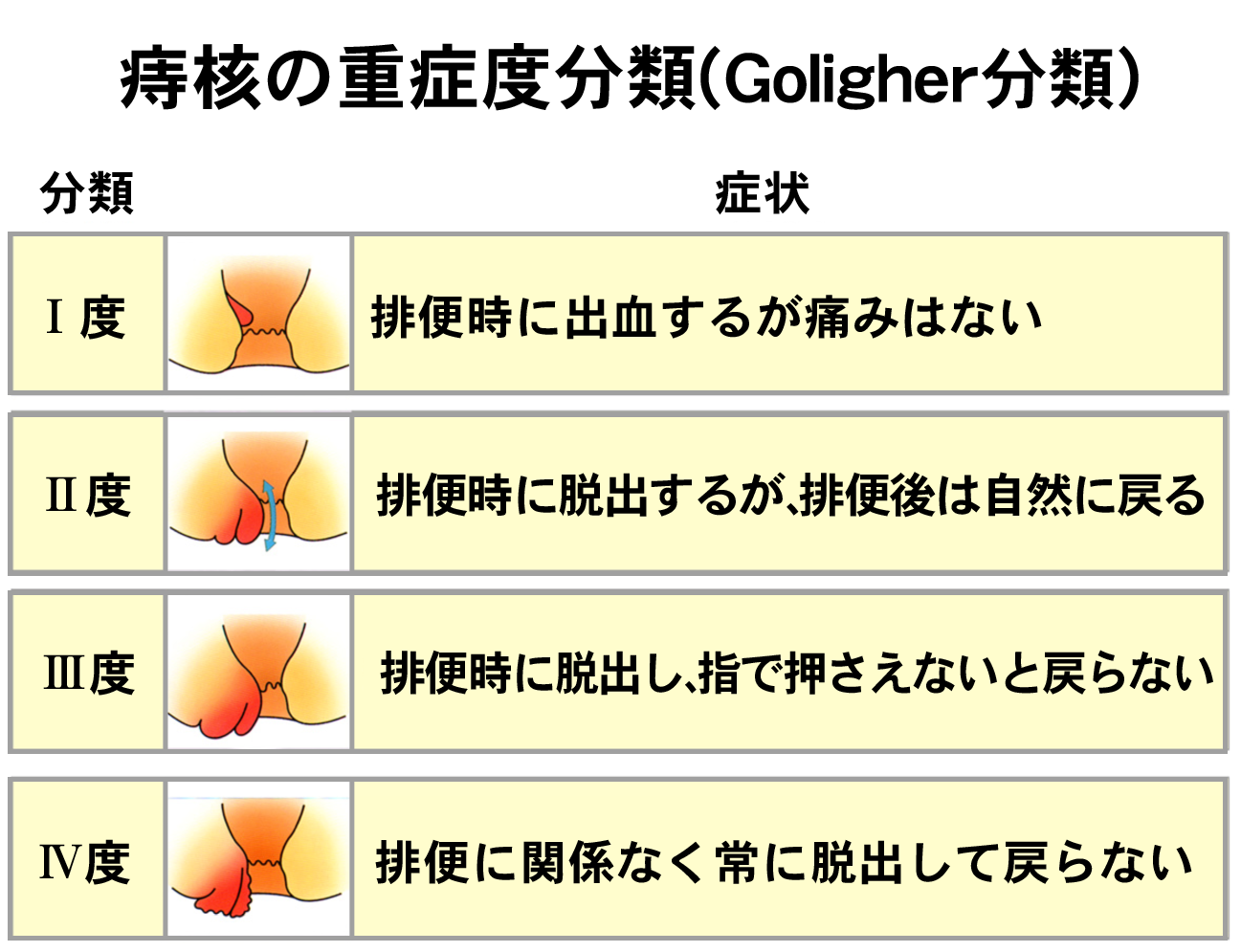痛くない痔の正体とは？出血の理由と放置厳禁のサイン【2026年最新】