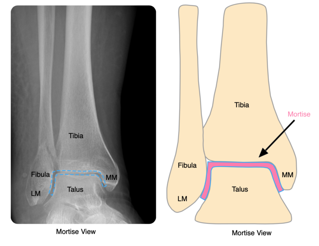 Mortise Ankle Joint