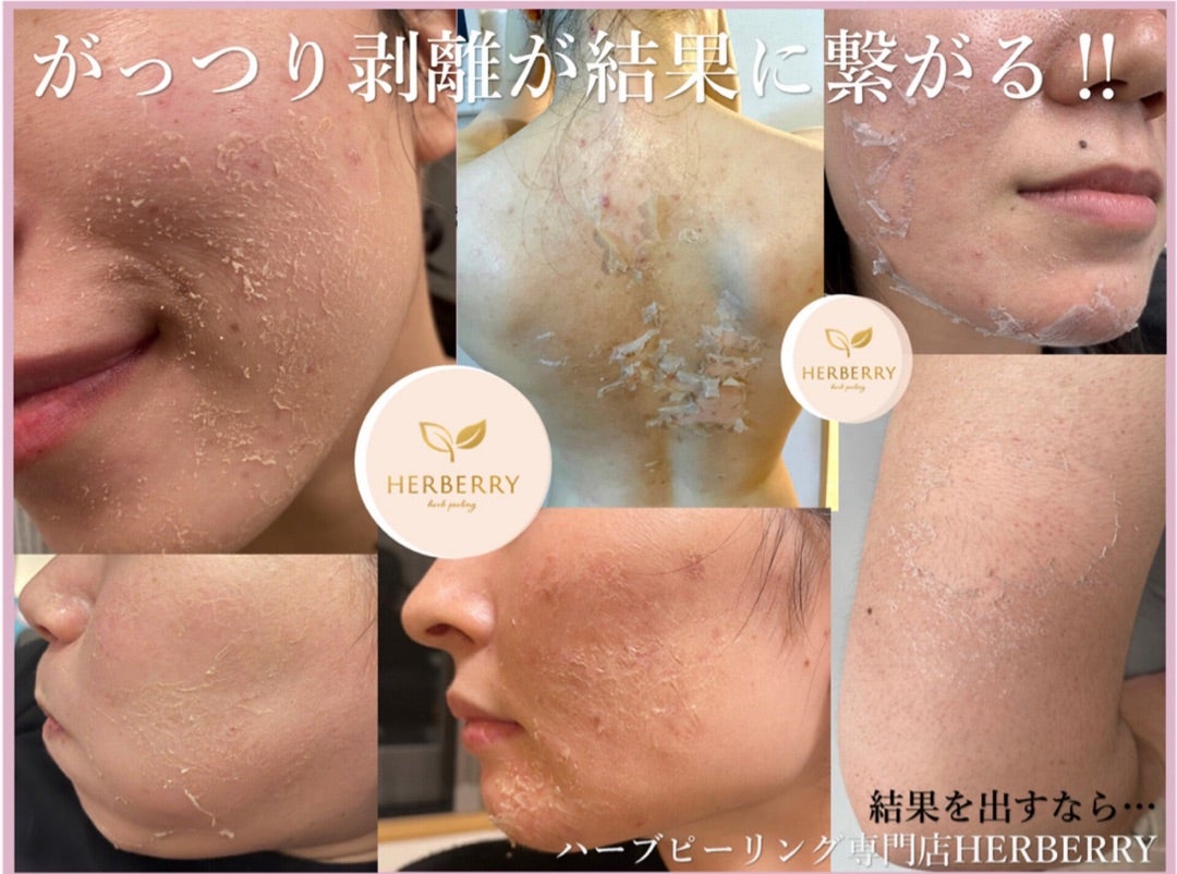 ハーブピーリング剥離の経過と期間！失敗を防ぐケアと痛みの真相