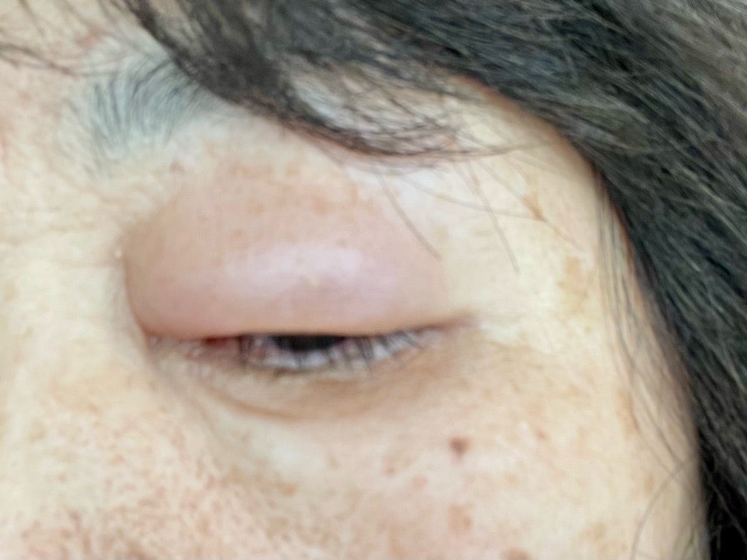 目の周りの蕁麻疹はなぜ起きる？腫れ・かゆみの原因と受診科の判断基準