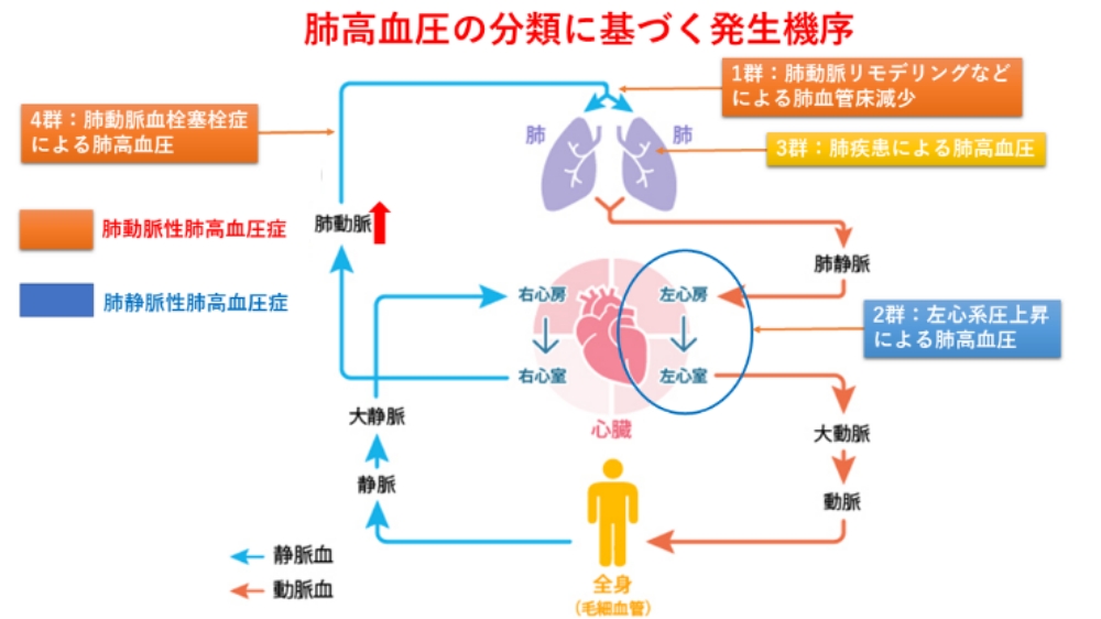 【2026年医療最前線】静かに進行する難病「肺高血圧症」の真実—早期発見を可能にする最新診断と劇的に進化する治療選択肢