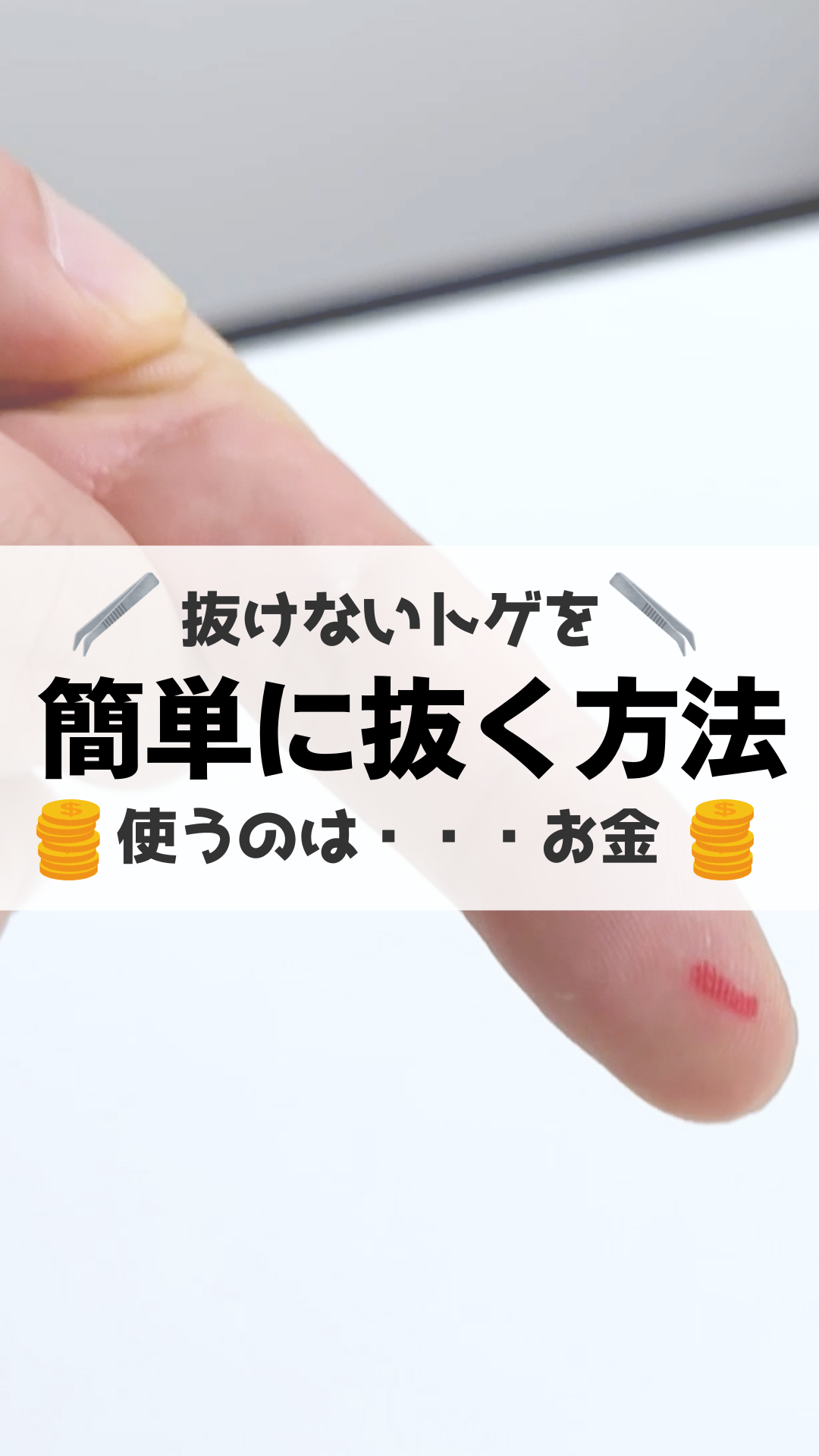 指のとげが抜けない！痛くない取り方と皮膚科受診の目安【2026最新】