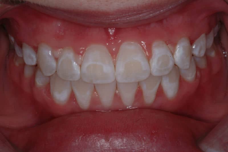 White Patches on Teeth After Whitening