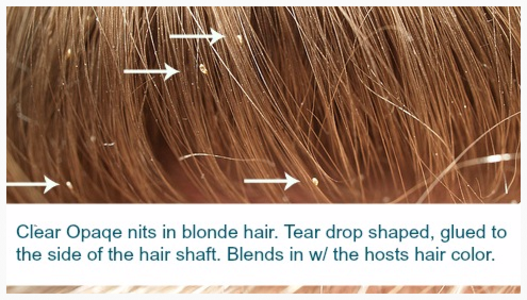 Nits in Blond Hair
