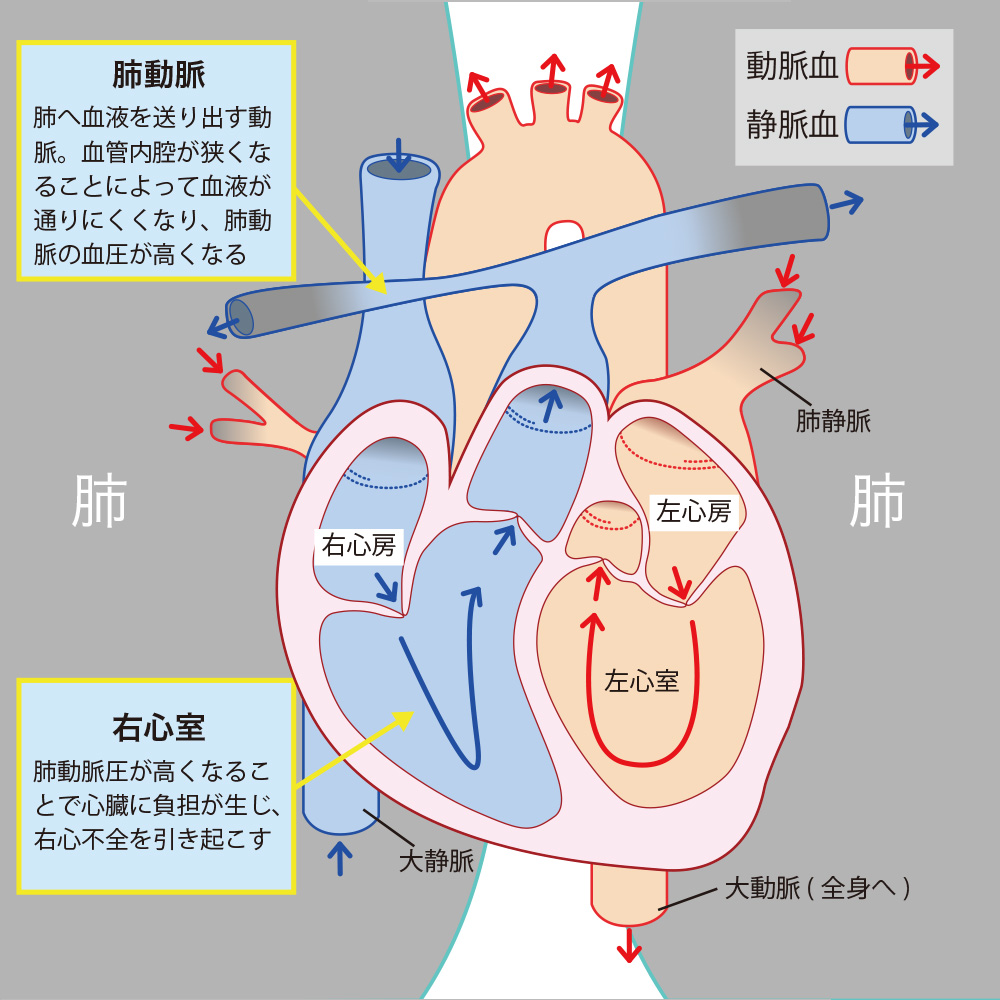 気管支拡張症の症状と悪化のサイン｜咳・血痰の真相と2026年最新治療