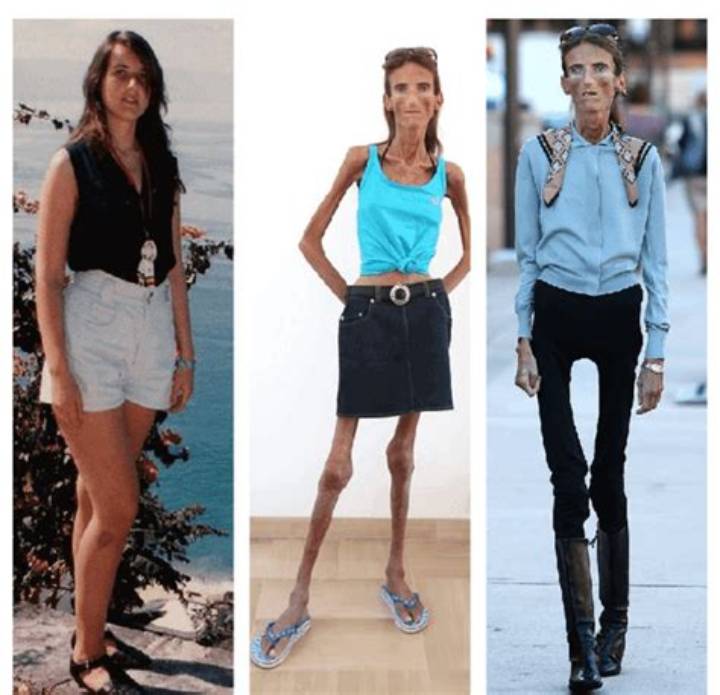 Who Is the Skinniest Person in the World? What “Skinniest” Really Means